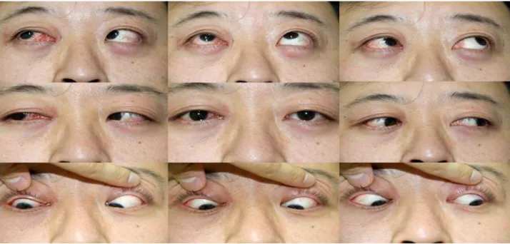 Figure 3. Nine postoperative positions of gaze 6 months after the operation. Improved abduction and supraduction of the right eye was noted.