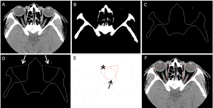 Figure 1. Volume measurement process of the computer program from axial scans images. (A) The original computed tomography  (CT) axial scan image