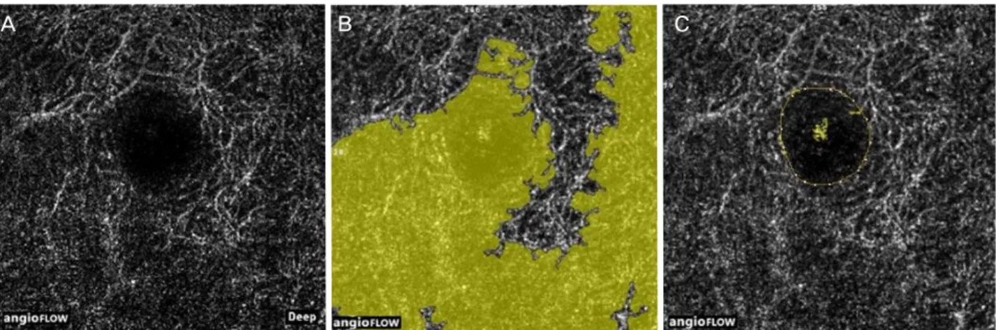 Figure 2. Manual adjustment of the foveal avascular zone (FAZ) boundary. (A) optical coherence tomography angiogram of the  macula in the deep capillary plexus