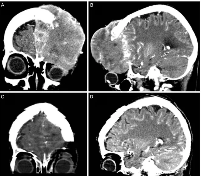 Figure 3. Pre-operative brain computed tomography. (A, B) 10.9 × 9.9 × 7.0 cm heterogeneously enhanced extra-axial scalp mass  with central necrosis on the left forehead
