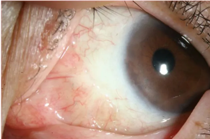 Figure 3. Conjunctival appearance at 6months after surgical  resection. The mass was completely removed and there was no  local recurrence