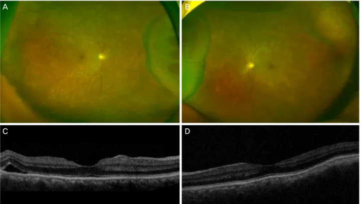 Figure 1. Initial ultra-wide fundus photography of the right eye, left eye and optical coherence tomography (OCT) of the right eye  and left eye