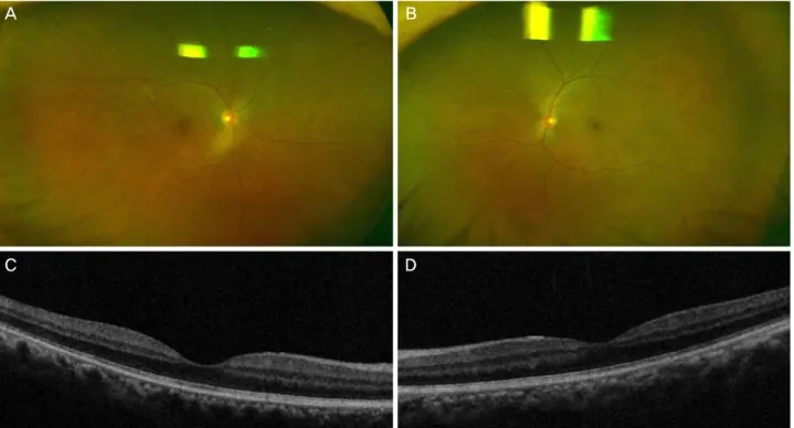 Figure 2. Seven days after the initial visit. Choroiditis and choroidal detachment in both eyes were decreased; right eye (A, C), and  left eye (B, D)