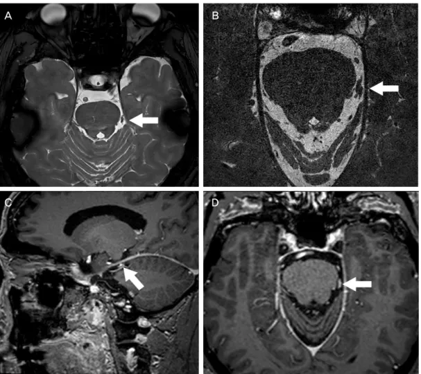 Figure 2. High-resolution magnetic resonance imaging of the trochlear nerve. (A, B) Axial T2-weighted images at the lower midbrain and upper pons reveal a 6 mm-sized lobulated trochlear nerve mass with low signal intensity (arrows)