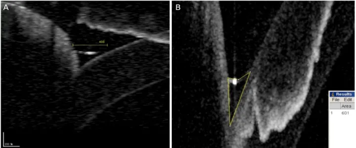 Figure 1. Tear meniscus measurement. (A) Optical coherence tomography image of the lower tear meniscus showing the tear me- niscus height
