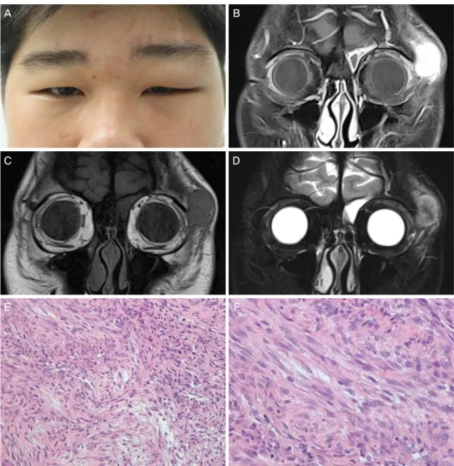 Figure 1. Clinical photograph, magnetic resonance images (MRI), and pathological findings of nodular fasciitis of 18-year old male  patient (case 1)