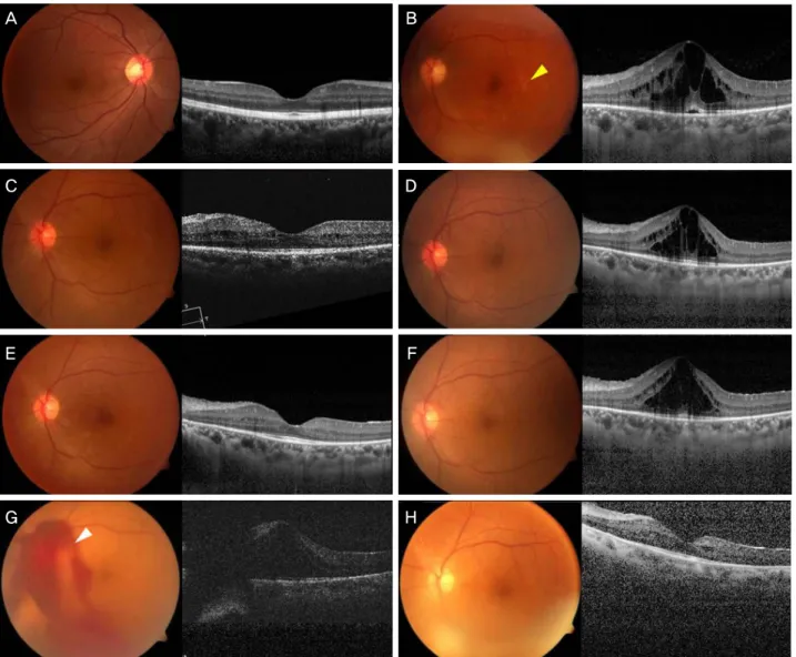 Figure 1. Serial changes of fundus color photographs and optical coherence tomography images of left eye