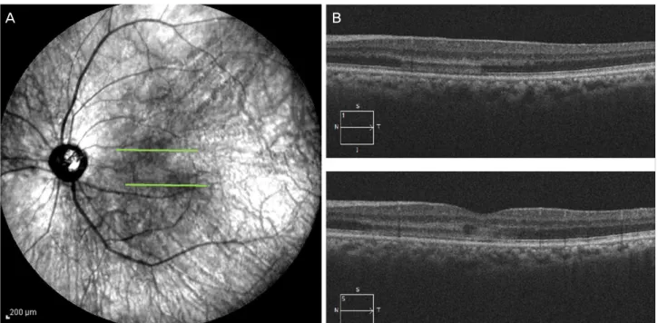 Figure 2. Near-infrared autofluorescence image of the patient. Near-infrared imaging presents multiple hyporeflective darker lesions in  left eye (A)