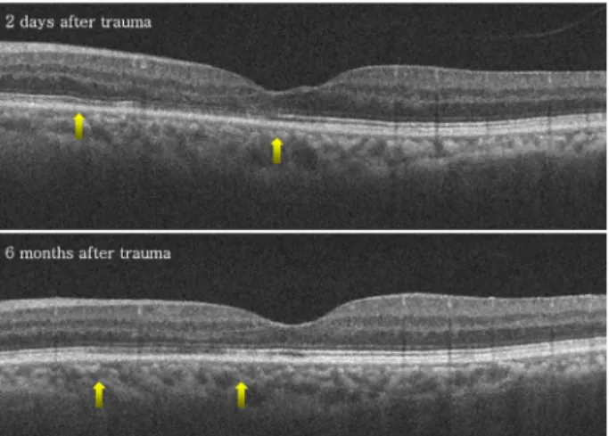 Figure 4.  Spectral domain optical coherence tomography im- ages of the left eye 2 days and 6 months after trauma