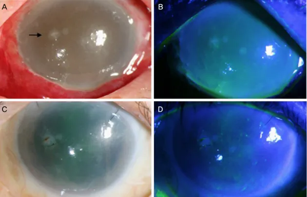 Figure 2. Slit-lamp biomicroscopic findings of case 2. (A, B) Initial presentation showed severe conjunctival chemosis, conjunctival  injection, and total epithelial defect with severe corneal edema