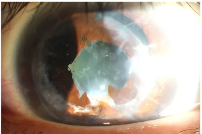 Figure 4. Case 12. Two months postoperatively, fixed dilated  pupil in the left eye.