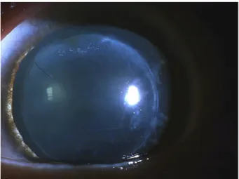 Figure 6. Case 13. Five years postoperatively, fully dilated  pupil in the left eye.