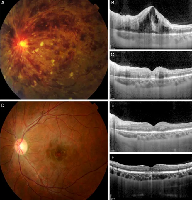 Figure 1. 21-year-old female patient presented with acute visual loss of left eye. Best corrected visual acuity in the left eye  was 0.3