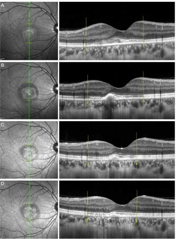 Figure 3. Optical coherence tomography (OCT) evaluation of the macular region in the vertical plane of the right  eye at initial presentation (A), and at one month (B), 19 months (C), 22 months (D) of follow-up