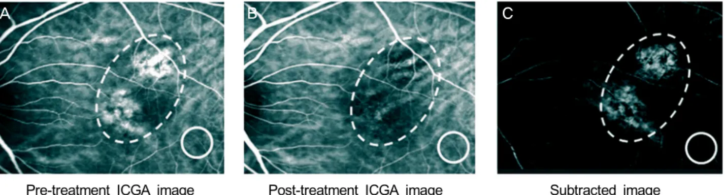 Figure 1. The method of calculating choroidal hyperpermeability changes after treatment of  chronic central serous chorioretinopathy.