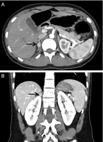 Figure 4. Thyroid ultrsonography shows 0.5 cm-sized irregu- irregu-lar marked hypoechogenic nodule (arrow) at the left mid-pole  (A) and 1.0 cm-sized irregular marked hypoechogenic nodule  at the right mid-pole (B).