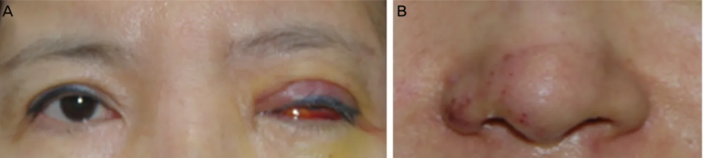 Figure 1. (A) Initial facial photographs show erythematous left eyelid swellings with blepharoptosis, severe conjunctival chemosis,  subconjunctival hemorrhage in the left eye and (B) purpura like rash at nasal ala and forehead.
