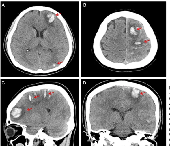 Figure 4. (A, B: axial  view), (C: sagittal view),  (D: coronal view) 4 days  after filler injection, brain  CT shows multiple  hyper-dense hemorrhages (arrows)  at left cerebral hemisphere (fro- ntal, temporal,  occi-pital, parietal lobes) which  mean hem