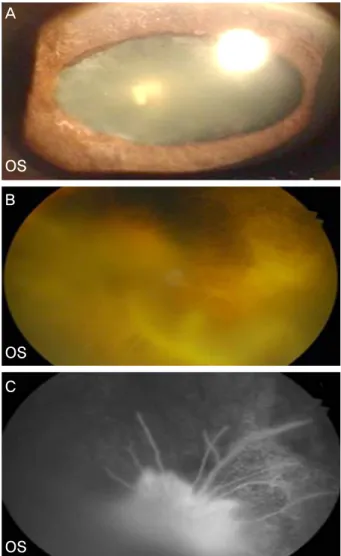Figure 5. 3 months after filler injection (A) anterior segment  photograph shows posterior synechiae and oval-shape fixed  pupil