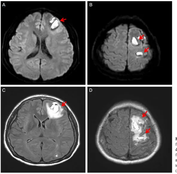 Figure 6. 3 months after  filler injection, (A, B: 
