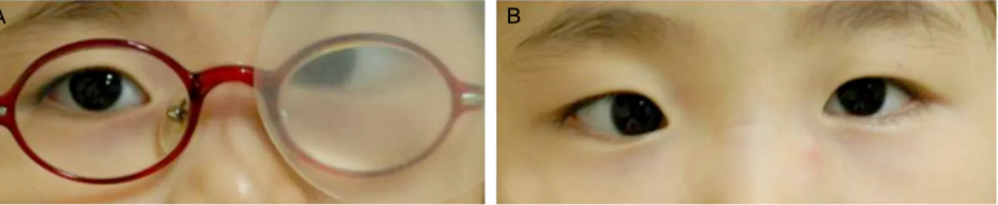 Figure 1. The eccentric fixation on the right eye (A), and left eye fixation without correction (B).찰이 필수적이다