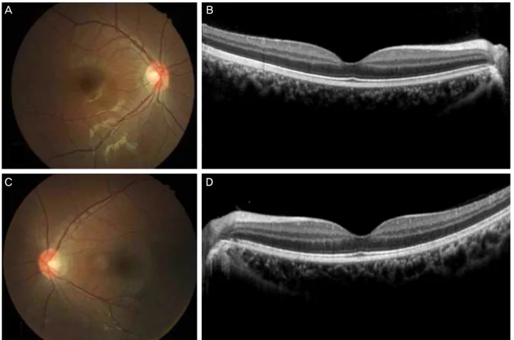 Figure 3. At the age of 11 years, the color fundus photographs (A, C) and the spectral-domain optical coherence tomography (B, D)  were normal in the both eyes