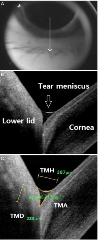 Figure 1. (A) Image illustrating the 6 mm vertical scan path  (arrowed line) of the optical coherence tomography beam to  im-age the lower tear meniscus
