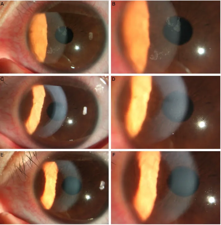 Figure 1. Slit lamp photographs of case 1. (A, B) Before Nd:YAG laser anterior stromal puncture, the loose corneal epithelium was  noted