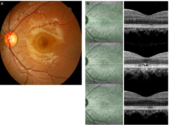 Figure 2. Fundus photograph (A) and SD-OCT (B) after 2 weeks of treatment show external limiting membrane, inner segment/out- segment/out-er segment line wsegment/out-ere partially restored, but retinal scar at the foveal area and retinal pigment epithelia