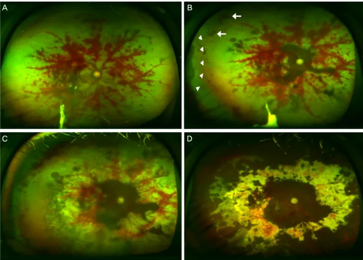 Figure 2. The progress of atypical acute retinal necrosis of the right eye. (A) On day 10, perivascular hemorrhage progressed to the  optic disc