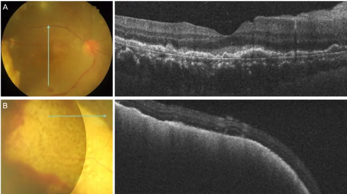 Figure 2. (A) A vertical optical coherence tomography scan across the central macula (arrow) shows multiple nodular elevations of  the retinal pigment epithelium
