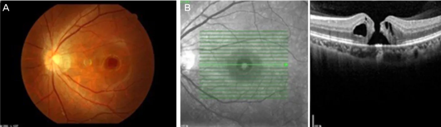 Figure 1. Preoperative fundus photography (A) and optical coherence tomography (B) of the left eye