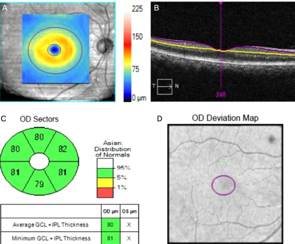 Figure 1. Cirrus HD-OCT images of the macula of the right eye. (A) GCIPL thickness maps (the denser the  orange/yellow ring, the thicker the GCIPL) (B) Boundary lines drawn to measure GCIPL thickness