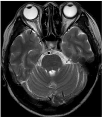 Figure 5. Fields of gazes at three  months after the injury show  re-covery of the extraocular muscle  movement in all directions
