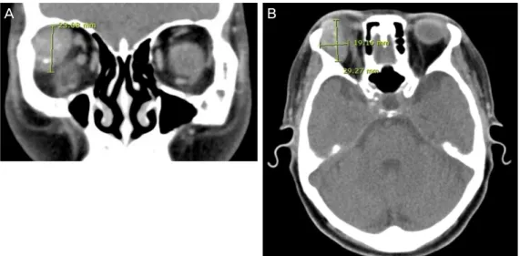 Figure 2. On CT image,  32 × 20 × 21 mm sized  well dermacated mass is  seen (A: coronal view; 