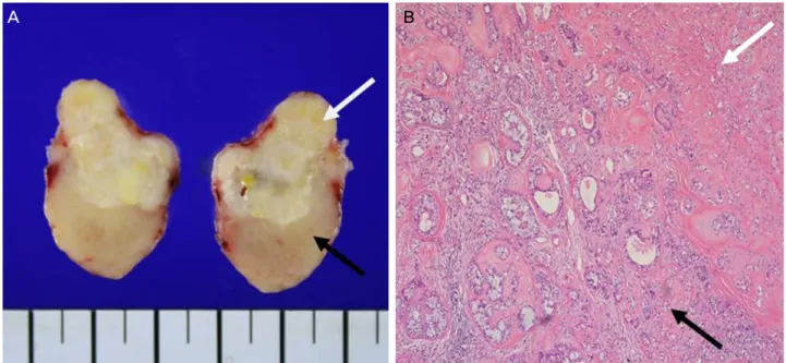 Figure 3. On cross sectional photo of excised mass (A), the pathologic finding of upper- nodular, translucent lesion has benign char- char-acteristics (white arrow), and lower- tan-yellow, firm mass with ill-defined lesion has malignant characterisctics (b