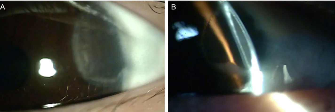 Figure 1. Slit-lamp appearance of initial presentation of sclerocorneal cyst. (A) A 4.2 × 3.5 mm sized cyst at superotemporal part of  cornea, partly filled with fluid and precipitates, extending into the sclera at 3-o’clock is seen