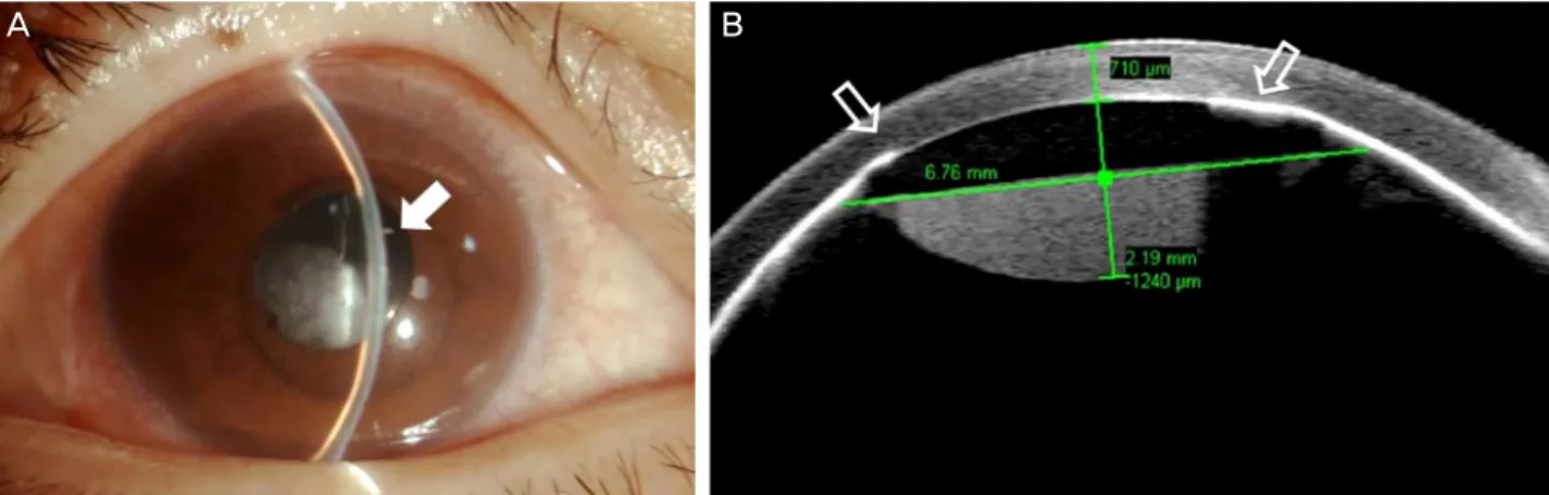 Figure 3. Anterior segment examination on the second day of visit. (A) Slit lamp examination