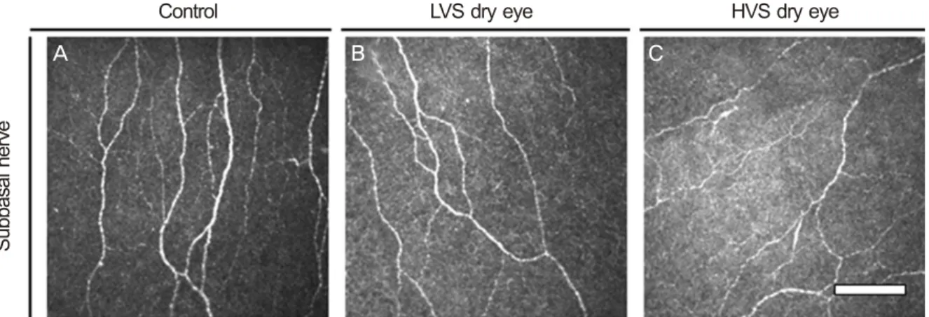 Figure 2. In vivo confocal images of cornea. Subbasal nerve. Compared with (A) and (B), (C) had more decreased subbasal nerve  density and had more increased subbasal nerve beadings, tortuosity, and reflectivity