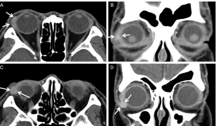 Figure 2. Orbital computed tomographic scans. (A, B) 0.6 cm sized homogenously enhancing mass was found just inferior to the  right lacrimal gland (arrows)