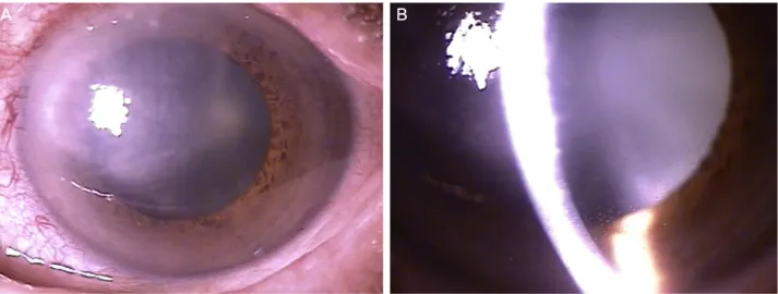 Figure 2. At the first visit. (A) The left eye showed corneal edema and stromal keratitis