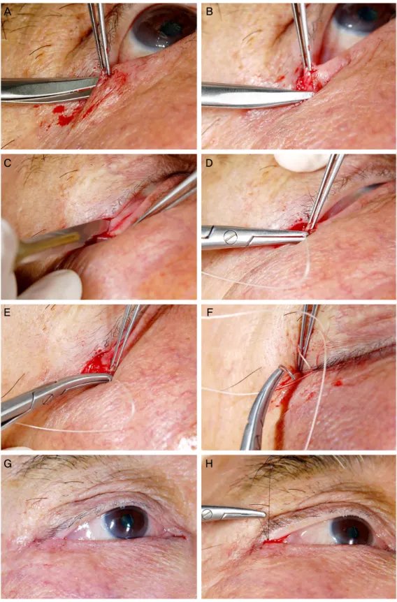 Figure 1. The lateral tarsal strip procedure. (A) After lateral canthotomy, the inferior crus of the lateral can- can-thal tendon was released
