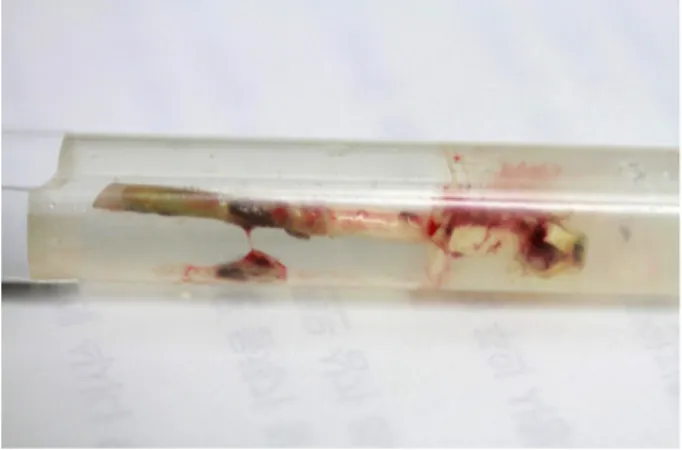 Figure 2. Song’s stent was removed at the postoperative 17  years after Song’s stent insertion due to the obstruction of  Song’s stent (Case 10).