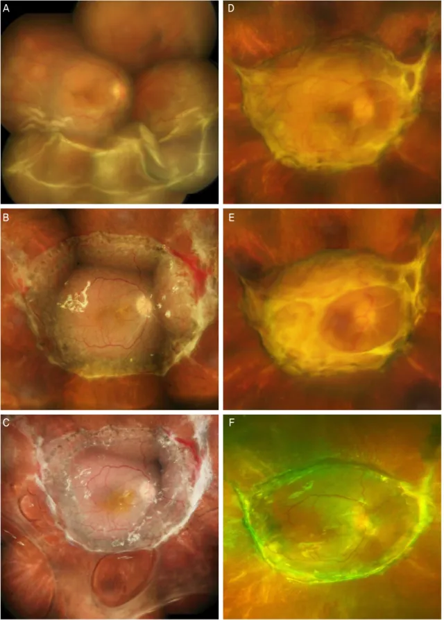 Figure 1. Consecutive fundus photos of a 25 year old male patient undergoing 5 repeated operations