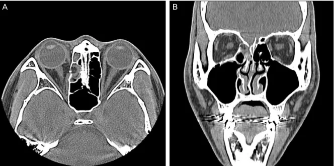 Figure 3. (A) Axial and (B) coronal computed tomography (CT) show an isolated small defect in the right medial wall with medial  rectus muscle incarcerated within the fracture.