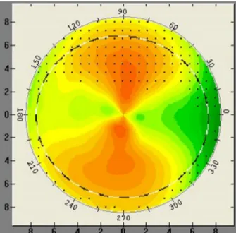 Figure 1. Corneal topography showing the limbus-to-limbus  corneal astigmatism.디자인을 통해,  일시적으로 근시를 감소시킴으로써 궁극적으로는 안축장의 증가를 유의하게 감소시켜 근시의 진행을 억제하는 것으로 알려져 있다.5구면 각막굴절교정 렌즈의 경우, 1.5 Diopter (D) 이상의 난시를 가진 환자들에서는 비교적 효과가 제한적이고,  렌즈의 중심이탈과 이로 인한 시력저하 및 불편감이 초래