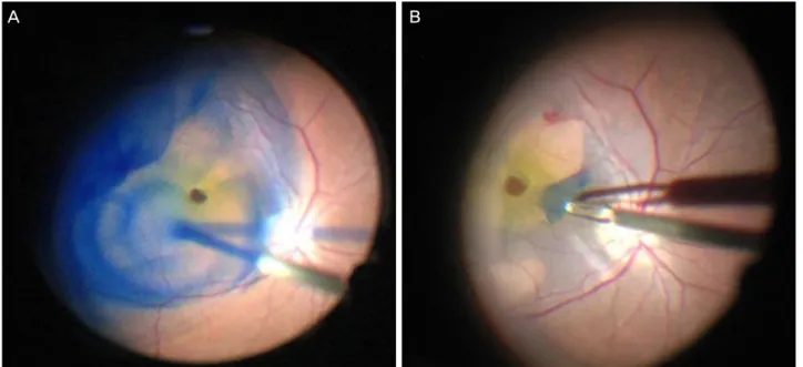 Figure 1. Intraoperative view of using 0.025% Brilliant Blue G (BBG). (A) During injection of 0.025% BBG for internal limiting  membrane (ILM) stain