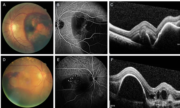 Figure 1. 60 year old man (A-C) and 84 years old man (D-F) with massive subretinal hemorrhage in a polypoidal choroidal  vasculopathy