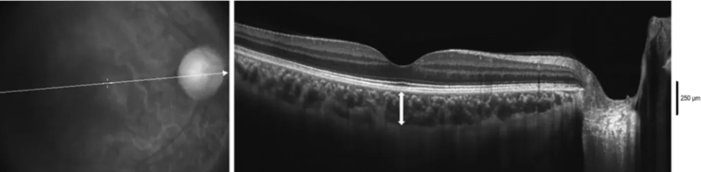 Figure 1. Choroidal thickness of the macula. The image was acquired using the RTVue FD-OCT