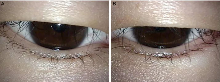 Figure 3. At the postoperative 6-month follow-up, there was no recurrence or inflammation at the operation site